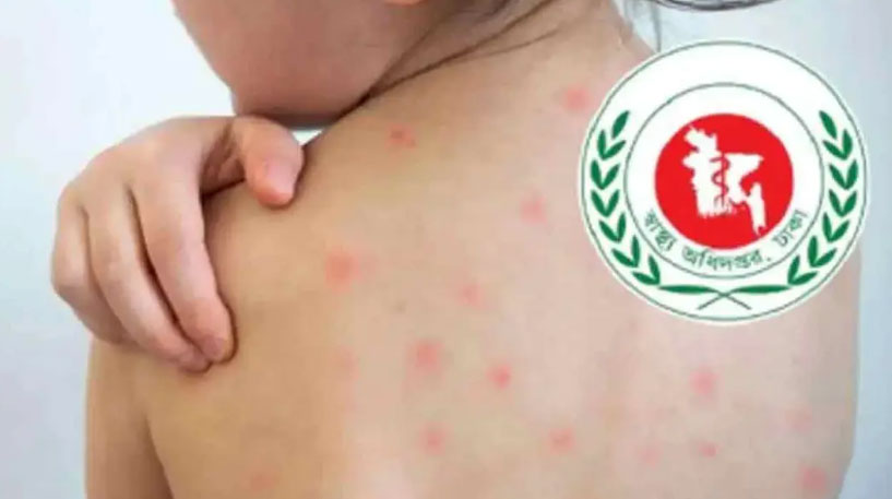 হামের উপসর্গে আরও ৭ মৃত্যু